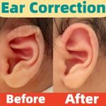Infant Stick Out Ear correction, Protruding Ear Corrector