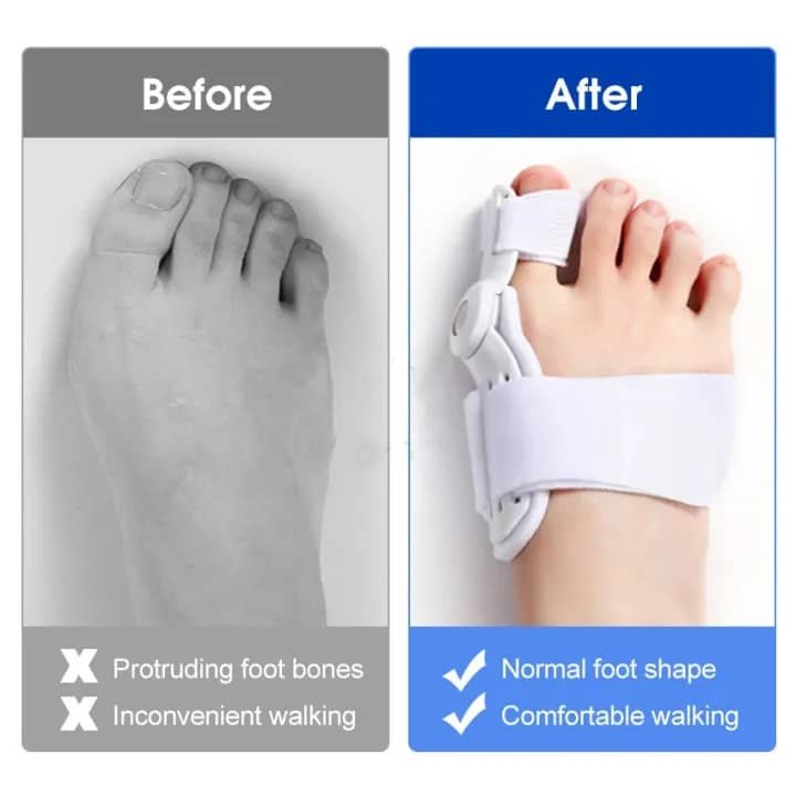 Toe Spacers for Bunions, Big Toe Stretcher 7 Toe Spacers for Bunions, Big Toe Stretcher 7