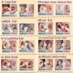 Prominent Ear Corrector Clip, Cup Ear Deformity Correction - Image 5