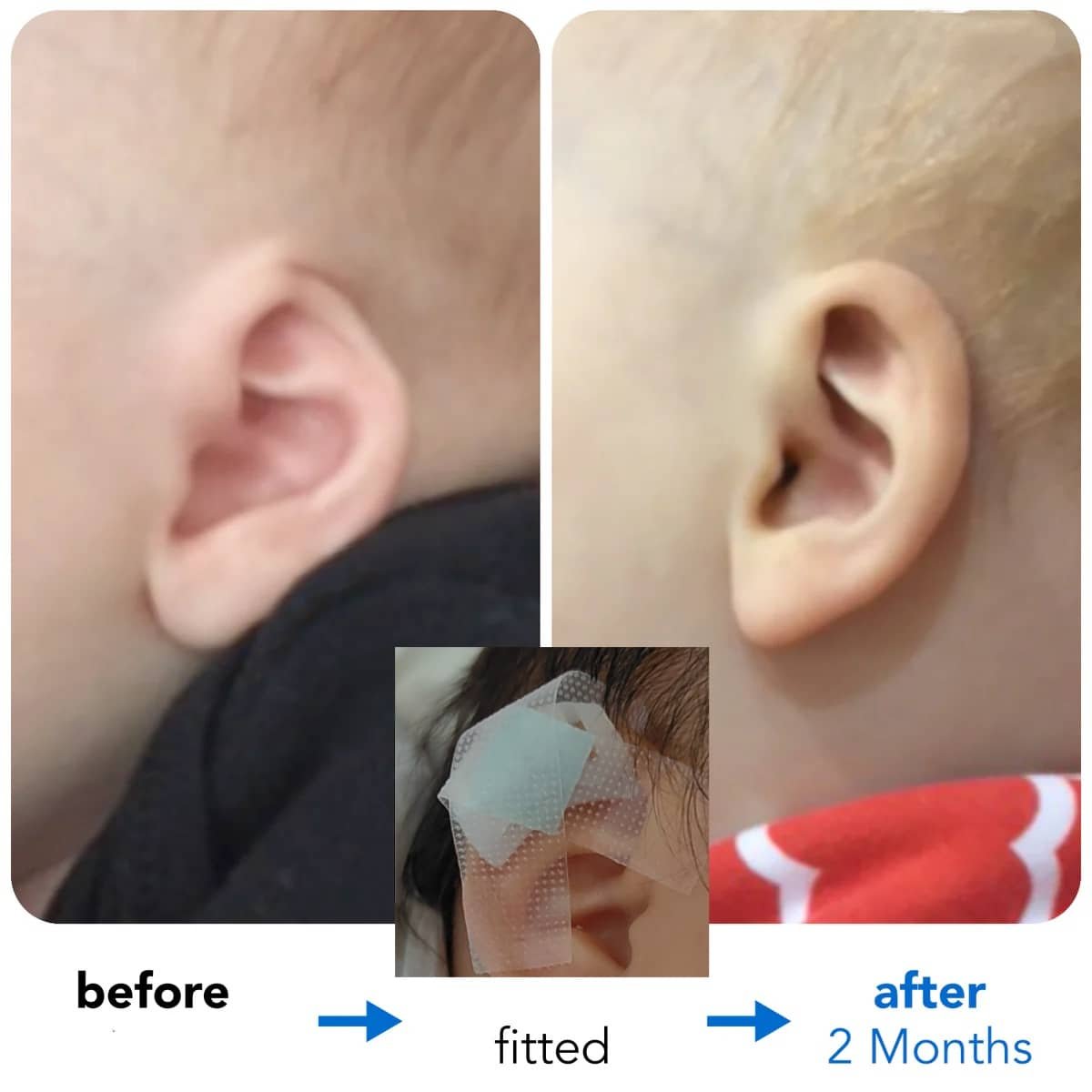 Cryptotia Ear Deformity Repair Treatment Non Surgical 1