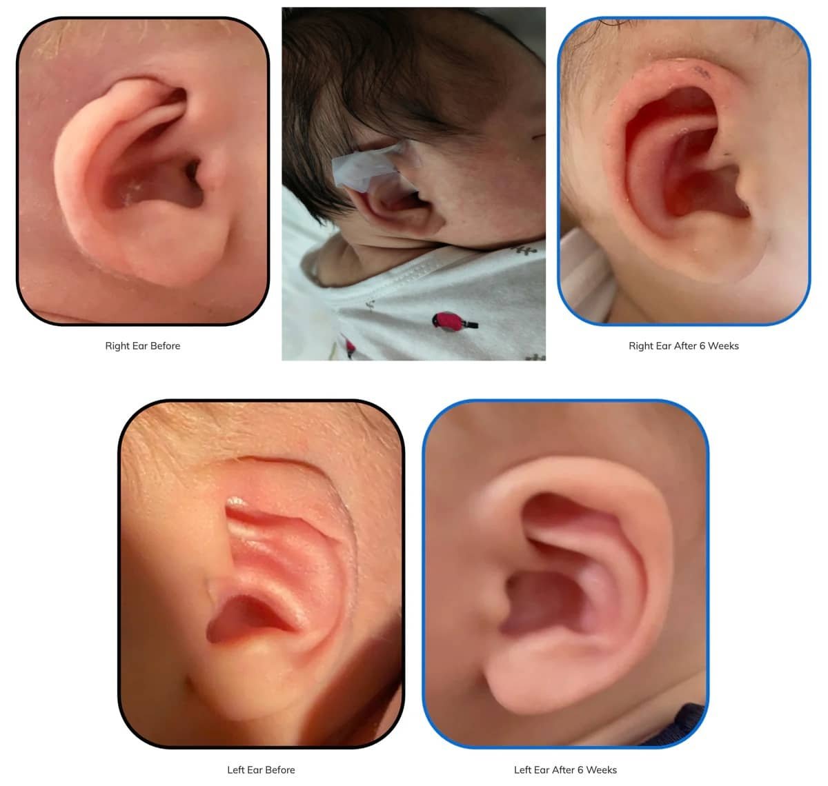 Cryptotia Ear Deformity Repair Treatment Non Surgical 2