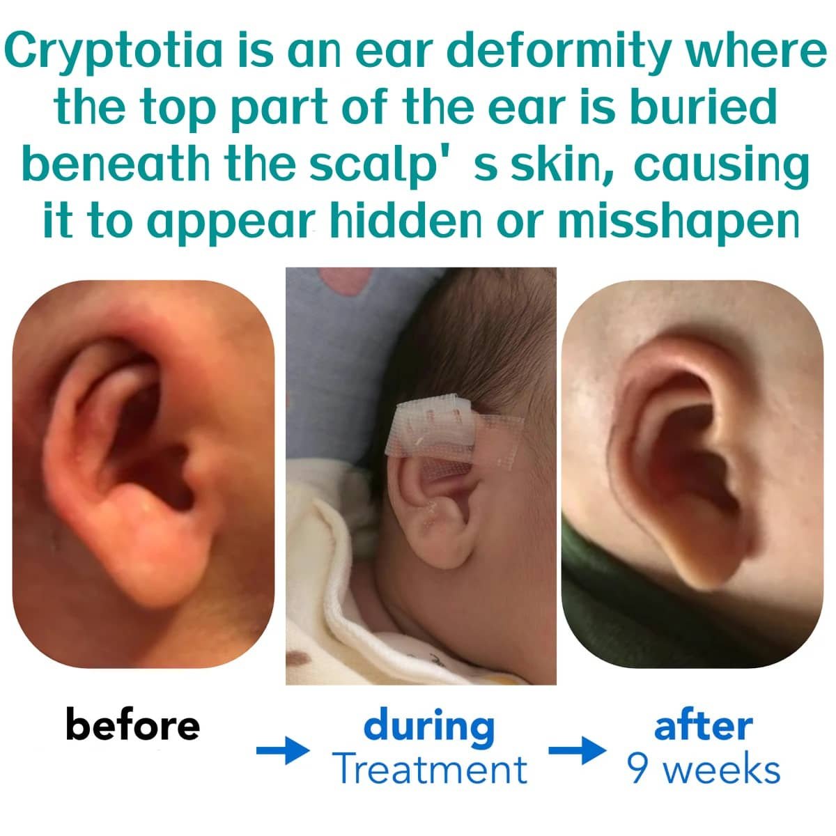 Cryptotia Ear Deformity Repair Treatment Non Surgical 3