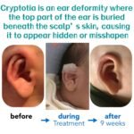 Cryptotia Ear Deformity Repair Treatment Non Surgical 3