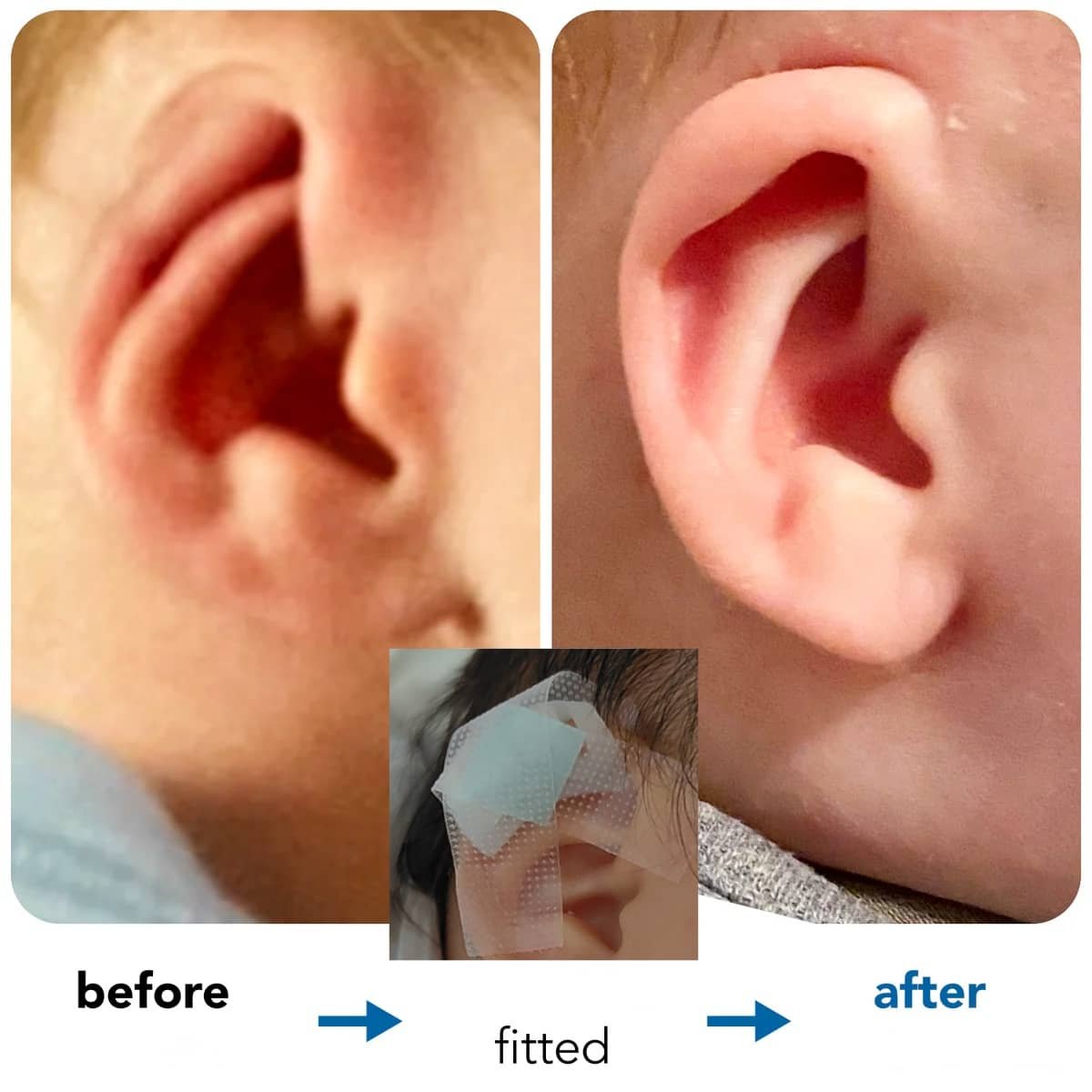Cryptotia Ear Deformity Repair Treatment Non Surgical Cryptotia Ear Deformity Repair Treatment Non Surgical