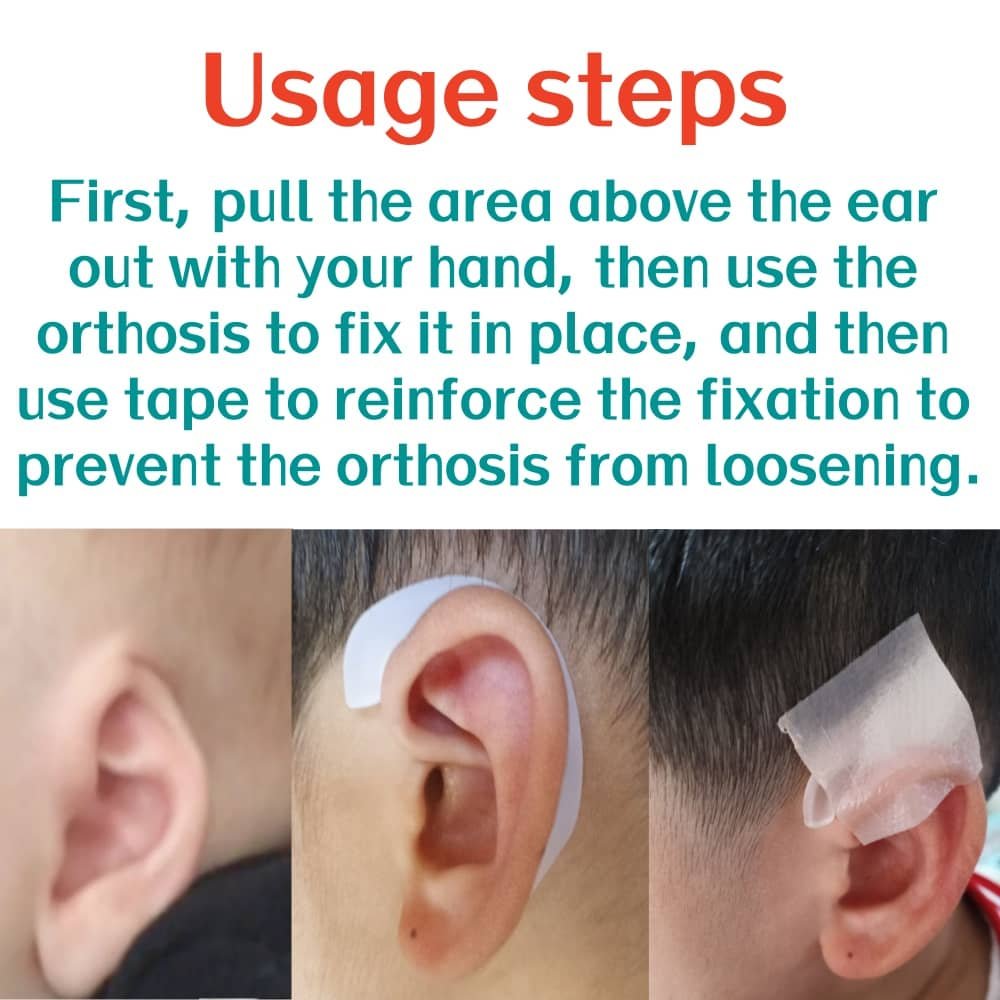 Cryptotia Ear Deformity Treatment Without Surgery, Fixing Repair Cryptotia Non Surgical 1