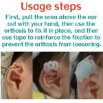 Cryptotia Ear Deformity Treatment Without Surgery, Fixing Repair Cryptotia Non Surgical