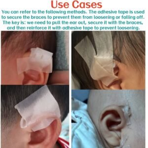 Cryptotia Ear Deformity Treatment Without Surgery, Fixing Repair Cryptotia Non Surgical 2