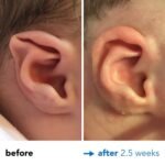 Fixing Stahls Bar Ear Deformity