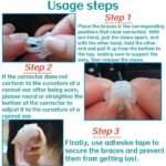 Lop Ear Deformity Correction Treatment For Baby & Adults 1