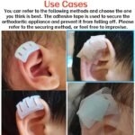 Lop Ear Deformity Correction Treatment For Baby & Adults