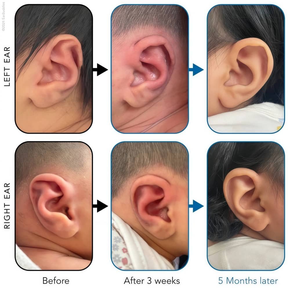 Stahl's Ear Correction Treatment 1
