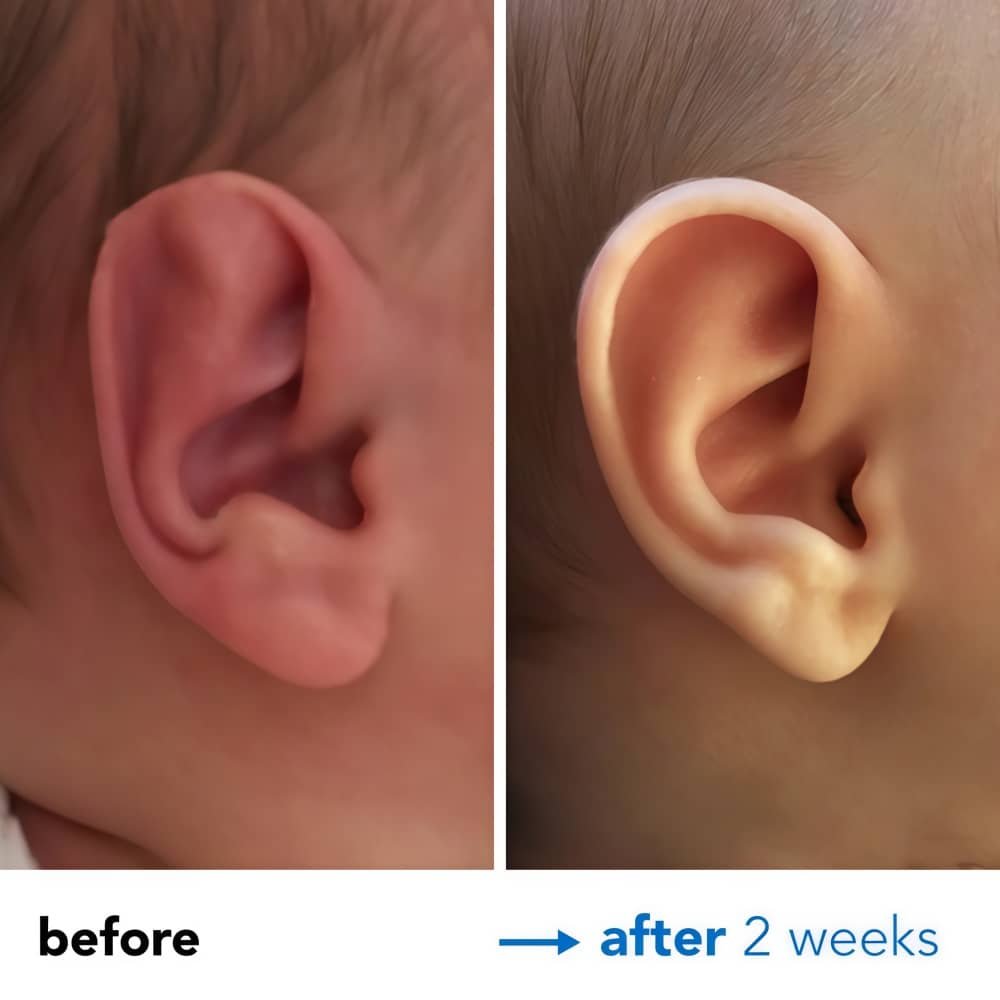 Stahl's Ear Correction Treatment