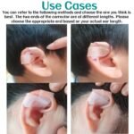 Stahl's Ear Correction Without Surgery 1