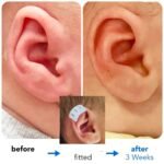 constricted ear in adults