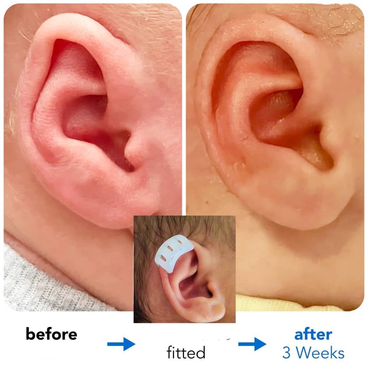 constricted ear in adults constricted ear in adults