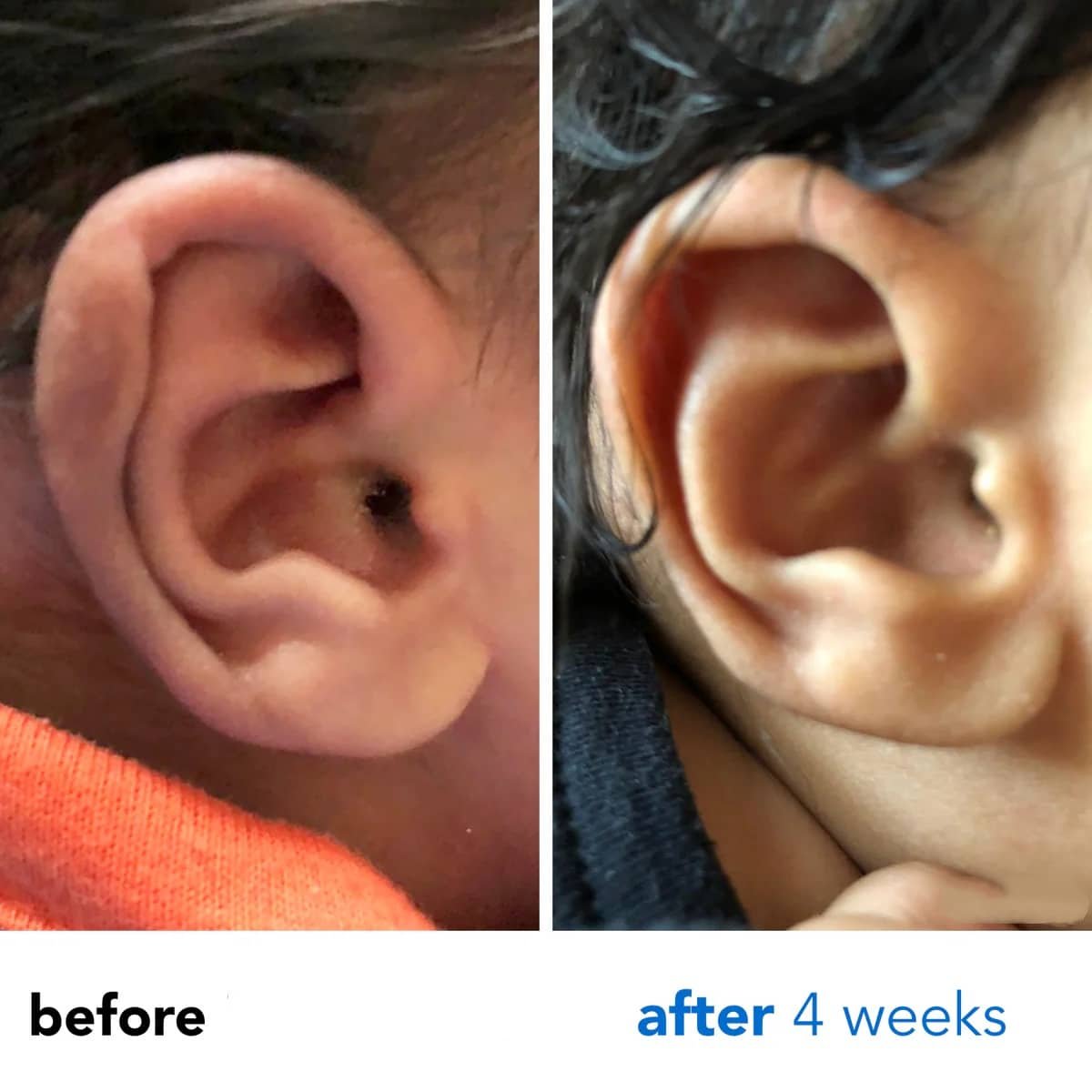 constricted ear treatment 1