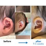 constricted ear treatment 3