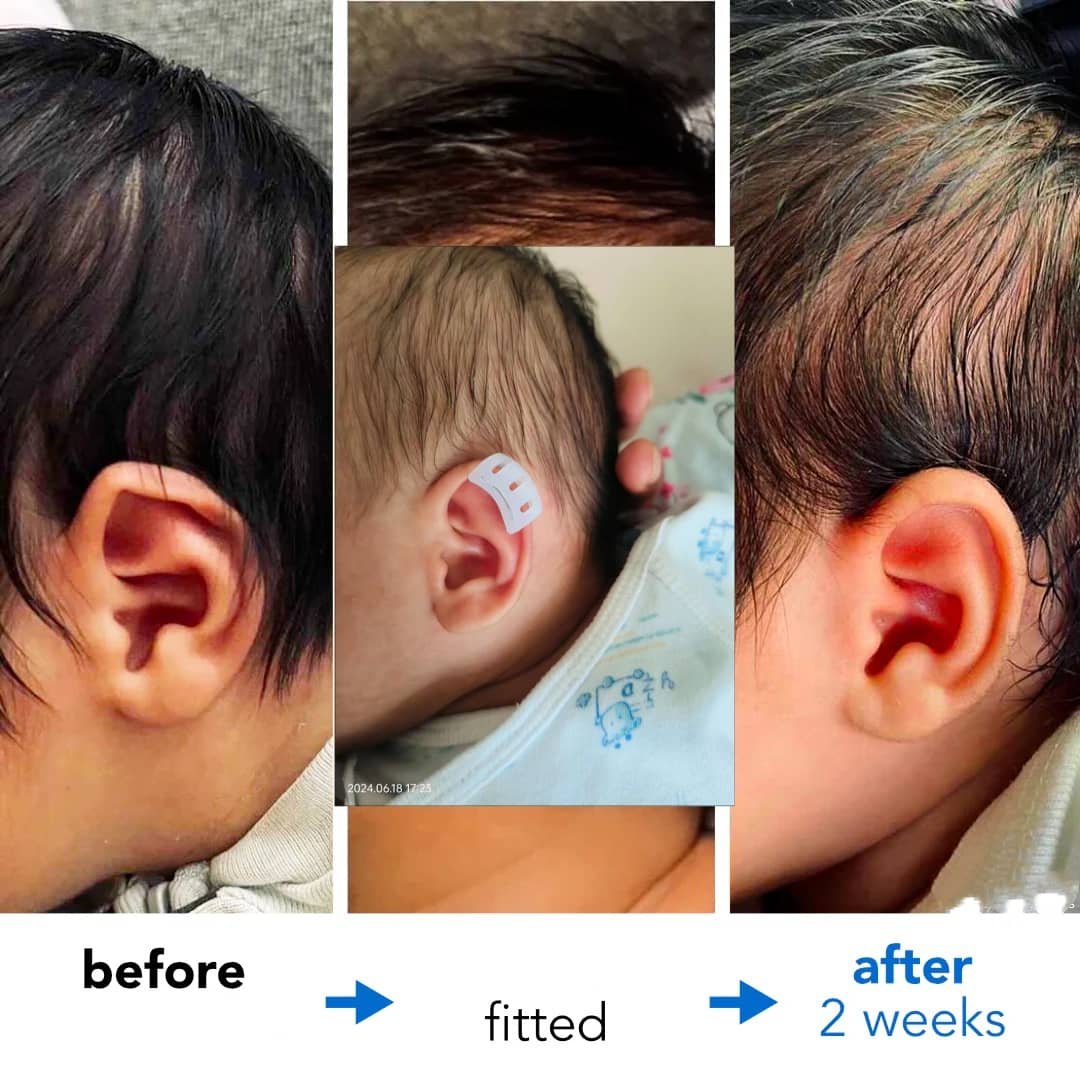 constricted ear treatment