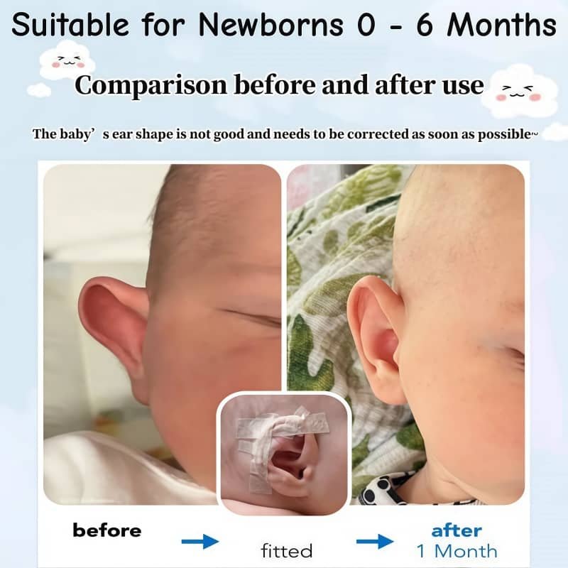 correcting ears that stick out 2 correcting ears that stick out 2