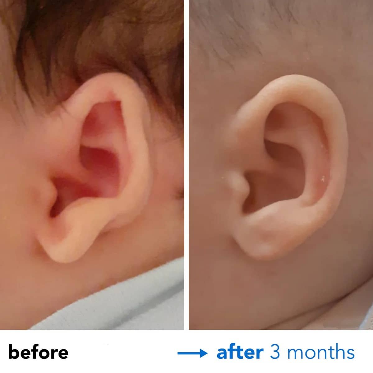 earlobes stick out 3