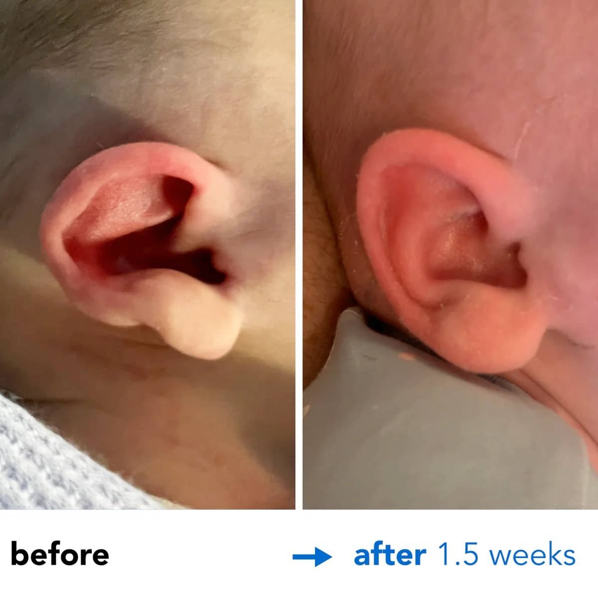 earlobes stick out 4