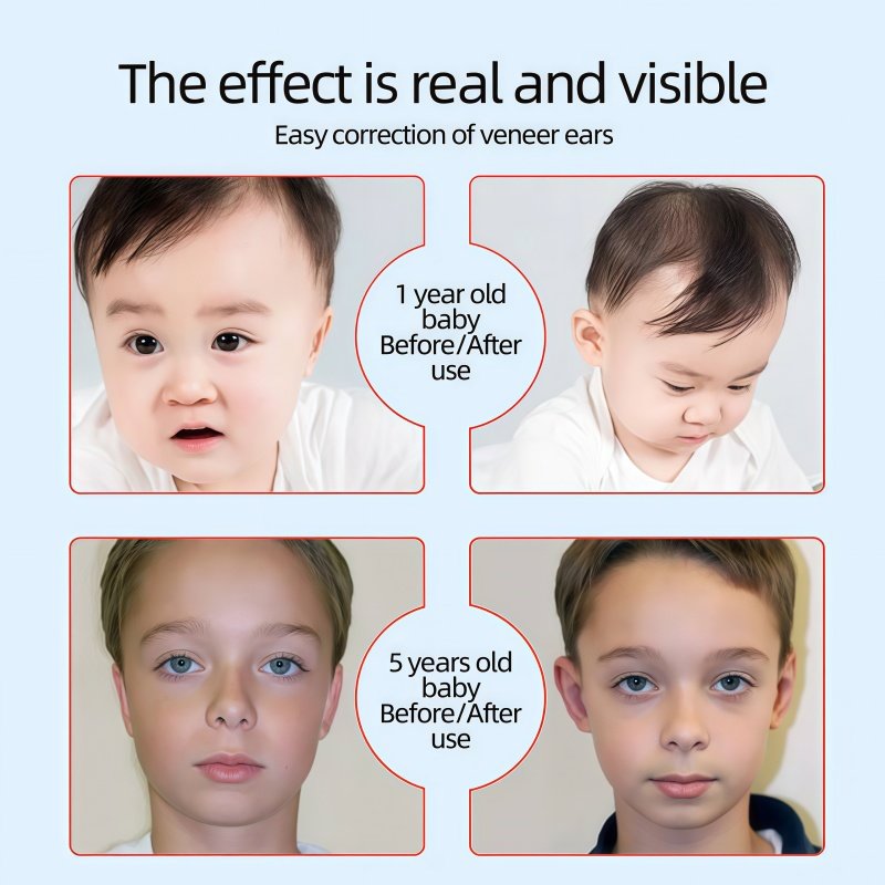 elf ear correction for Veneer Ears 2 elf ear correction for Veneer Ears 2