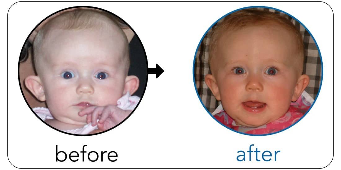 protruding ear correction without surgery 2