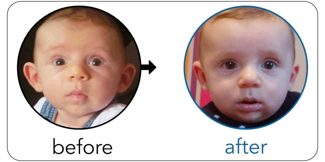 protruding ear correction without surgery 3