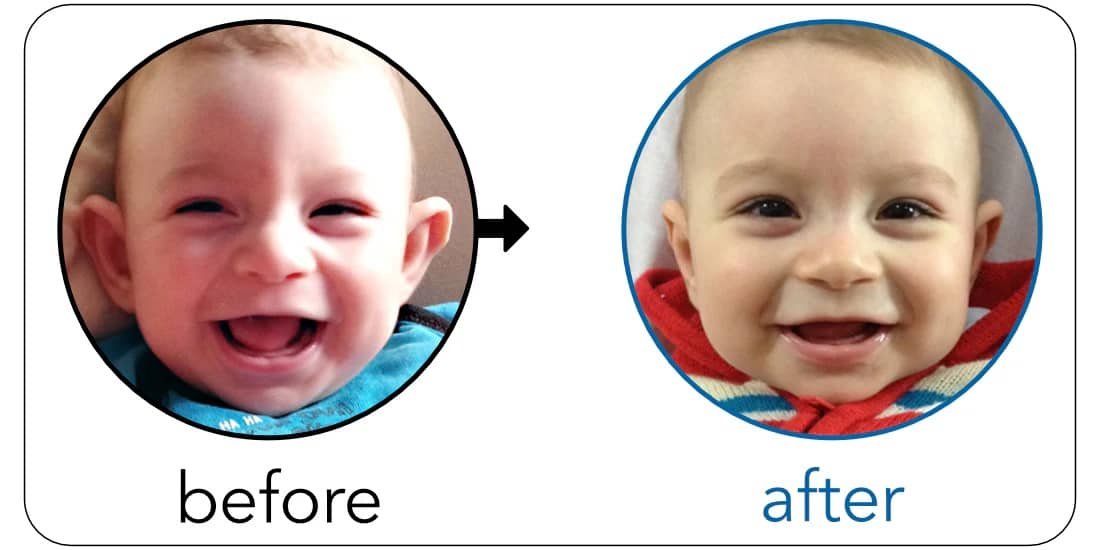 protruding ear correction without surgery 4