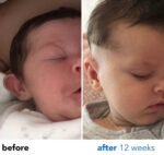 protruding ears non surgical