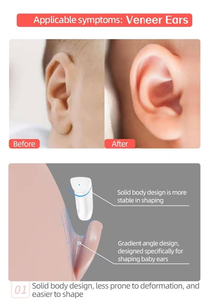 stand ear Corrector for Veneer Ears