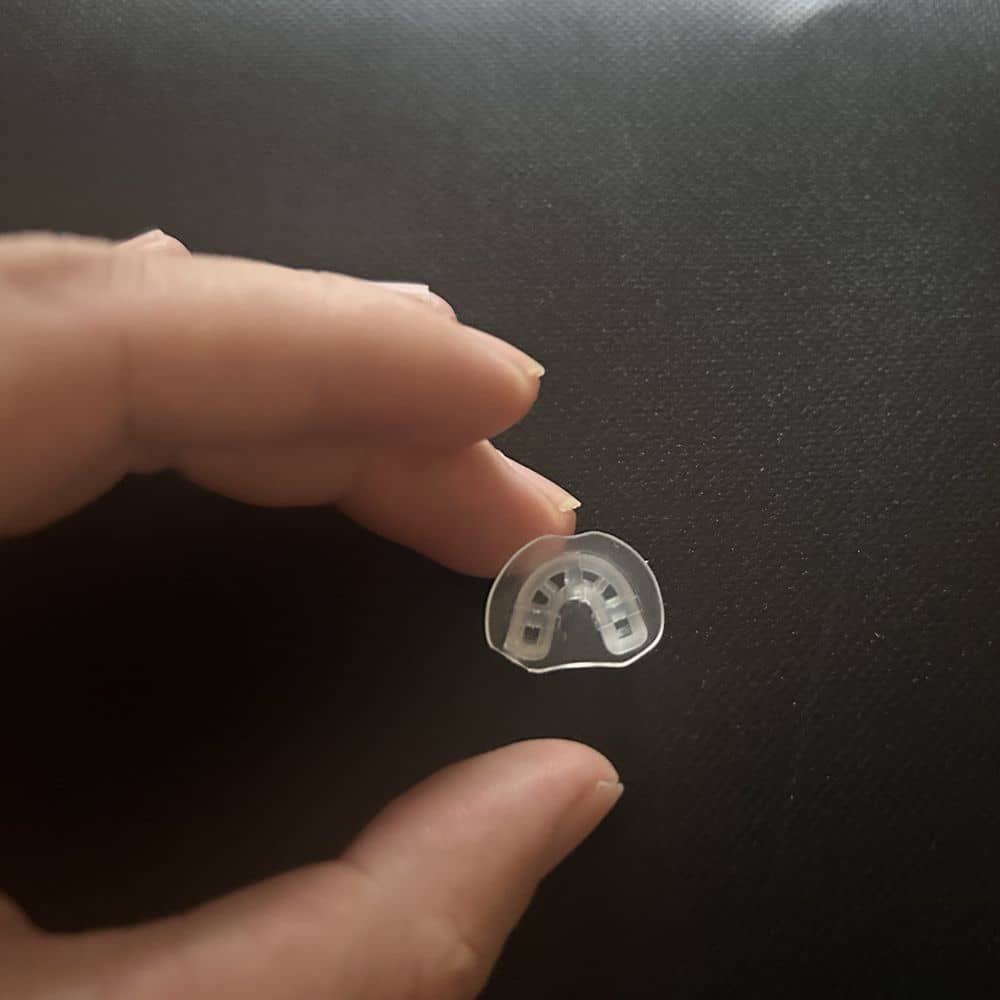 Fixing Conchal Crus Deformity Conchal Crus Ear Correction Without Surgery 1