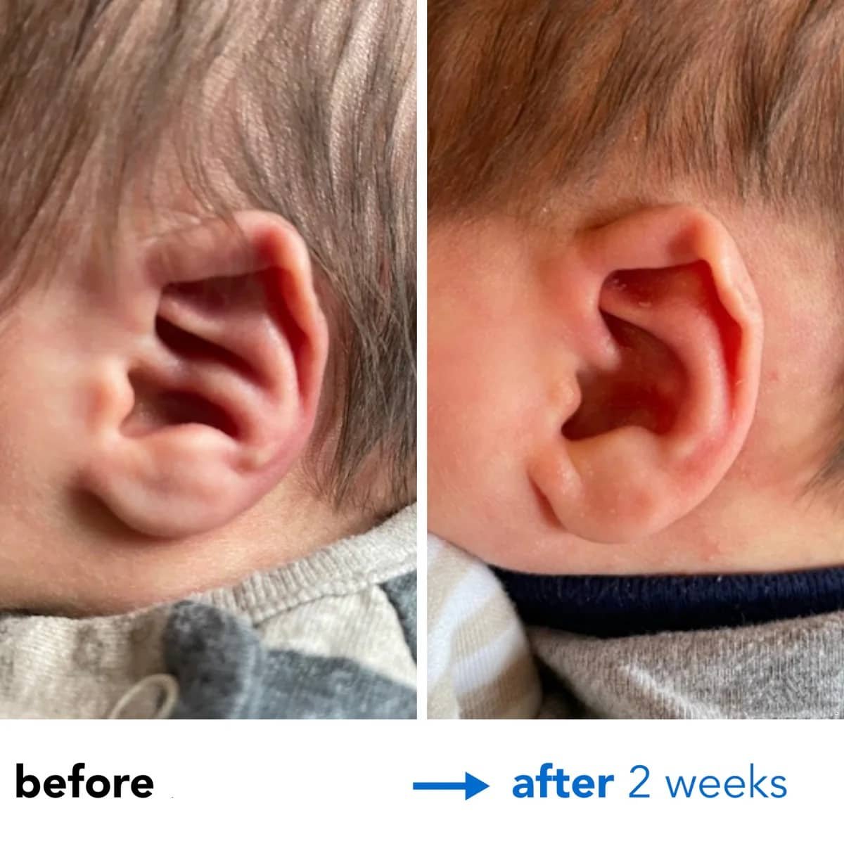 Fixing Conchal Crus Deformity Conchal Crus Ear Correction Without Surgery 10