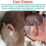 Fixing Conchal Crus Deformity Conchal Crus Ear Correction Without Surgery 11