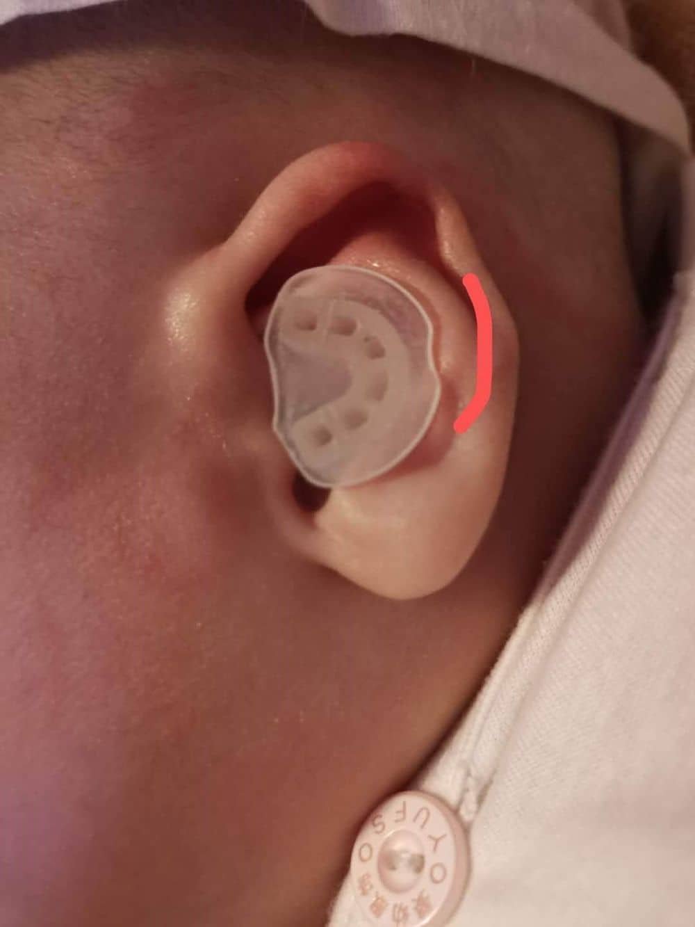 Fixing Conchal Crus Deformity Conchal Crus Ear Correction Without Surgery 2