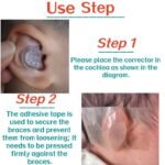 Fixing Conchal Crus Deformity Conchal Crus Ear Correction Without Surgery 5