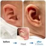 Fixing Conchal Crus Deformity Conchal Crus Ear Correction Without Surgery 6