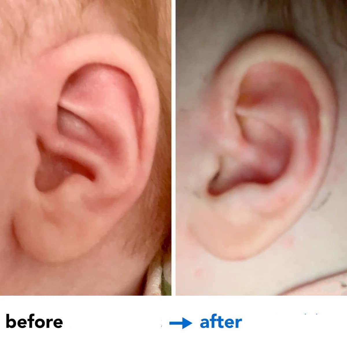 Fixing Conchal Crus Deformity Conchal Crus Ear Correction Without Surgery 7