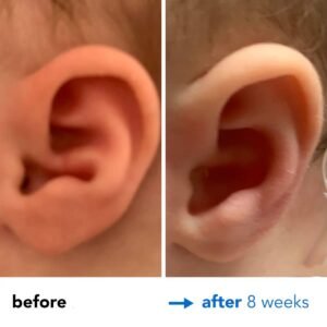 Fixing Conchal Crus Deformity Conchal Crus Ear Correction Without Surgery 8