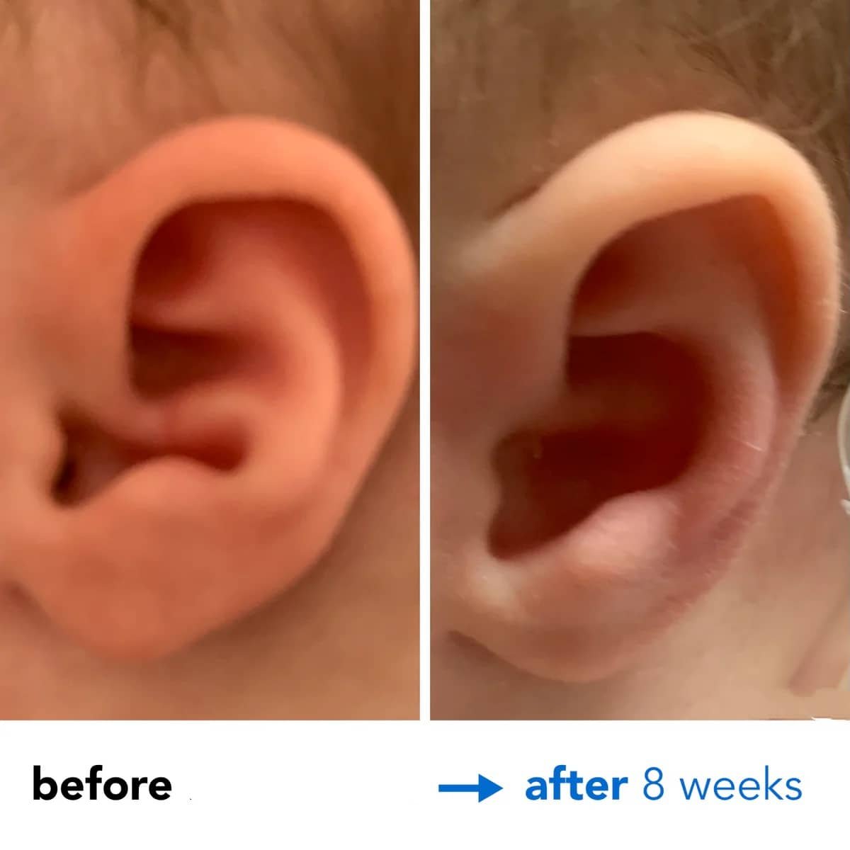 Fixing Conchal Crus Deformity Conchal Crus Ear Correction Without Surgery 8 Fixing Conchal Crus Deformity Conchal Crus Ear Correction Without Surgery 8