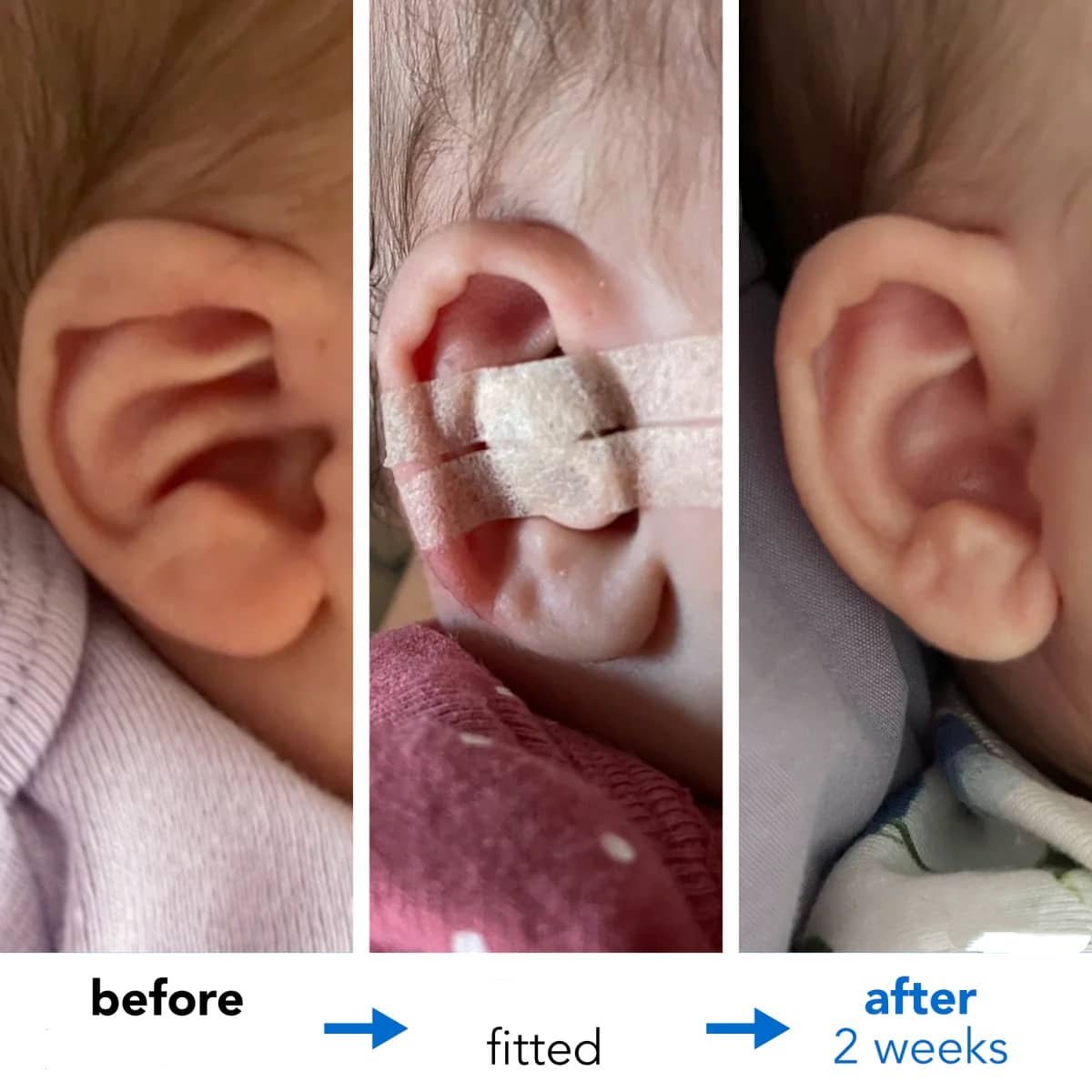Fixing Conchal Crus Deformity Conchal Crus Ear Correction Without Surgery 9